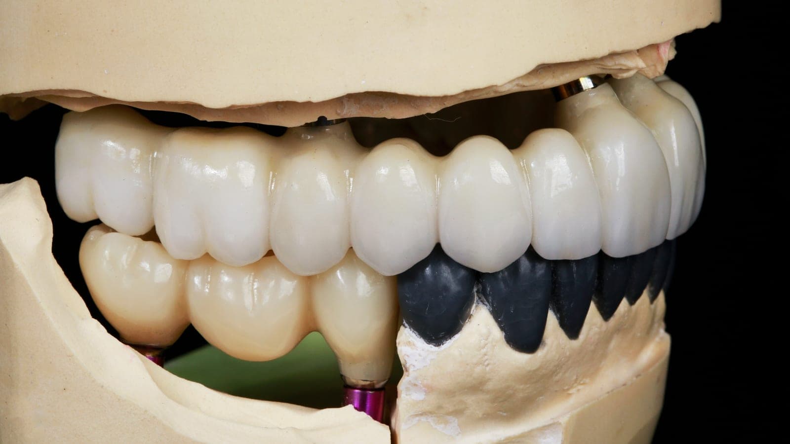 A natural-looking denture and bridge model at Chapel House Dentistry