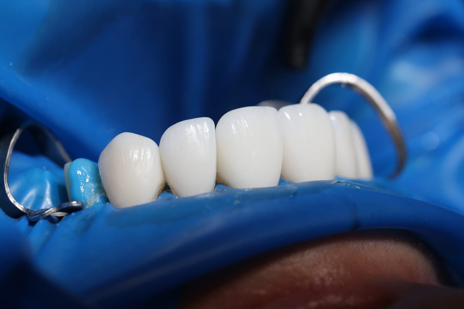 Close-up of careful restorative dental treatment at Chapel House Dentistry